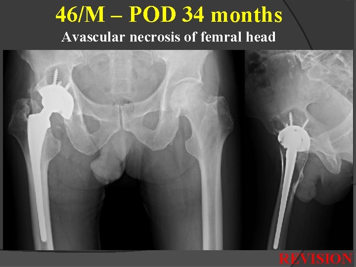 46/M – POD 34 months Avascular necrosis of femral head REVISION 