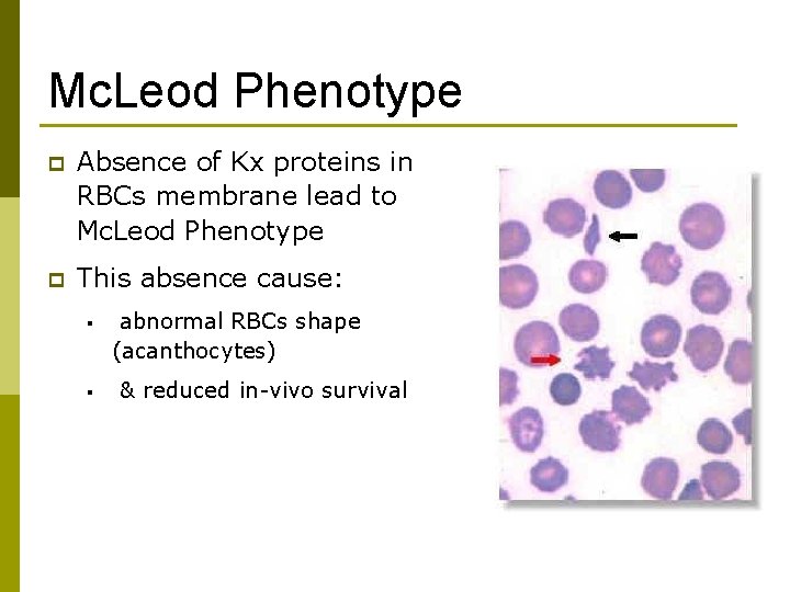 Mc. Leod Phenotype p Absence of Kx proteins in RBCs membrane lead to Mc.