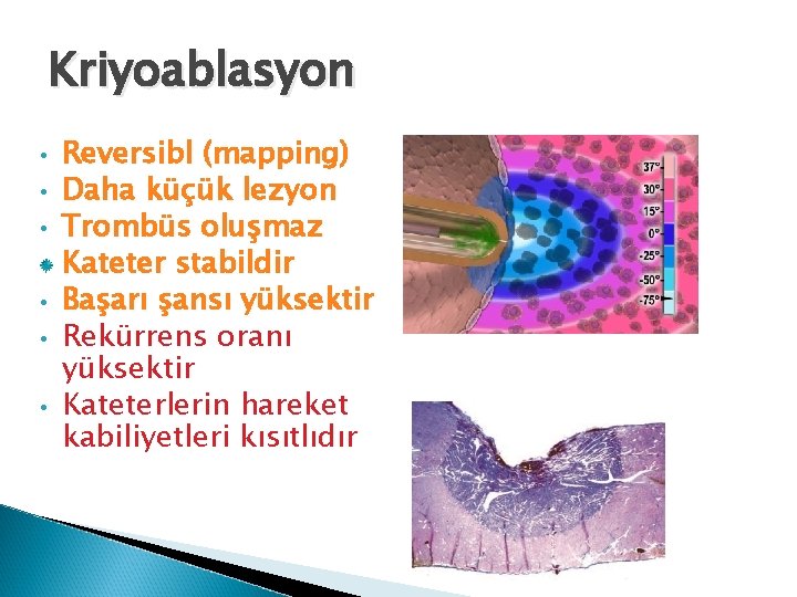 Kriyoablasyon • • • Reversibl (mapping) Daha küçük lezyon Trombüs oluşmaz Kateter stabildir Başarı