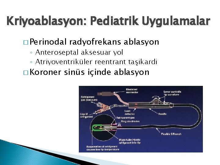 Kriyoablasyon: Pediatrik Uygulamalar � Perinodal radyofrekans ablasyon ◦ Anteroseptal aksesuar yol ◦ Atriyoventriküler reentrant