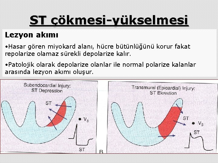 ST çökmesi-yükselmesi Lezyon akımı • Hasar gören miyokard alanı, hücre bütünlüğünü korur fakat repolarize