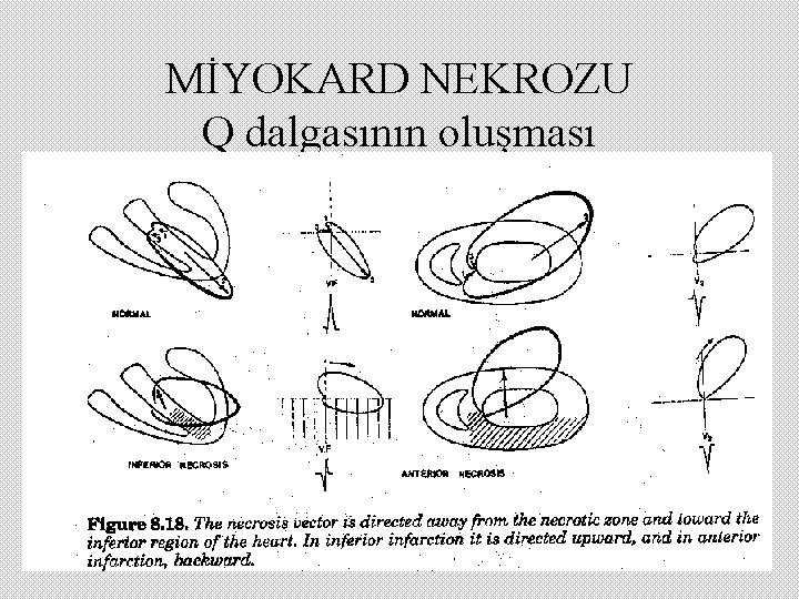 MİYOKARD NEKROZU Q dalgasının oluşması 