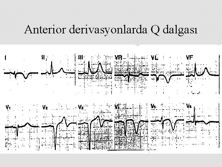 Anterior derivasyonlarda Q dalgası 