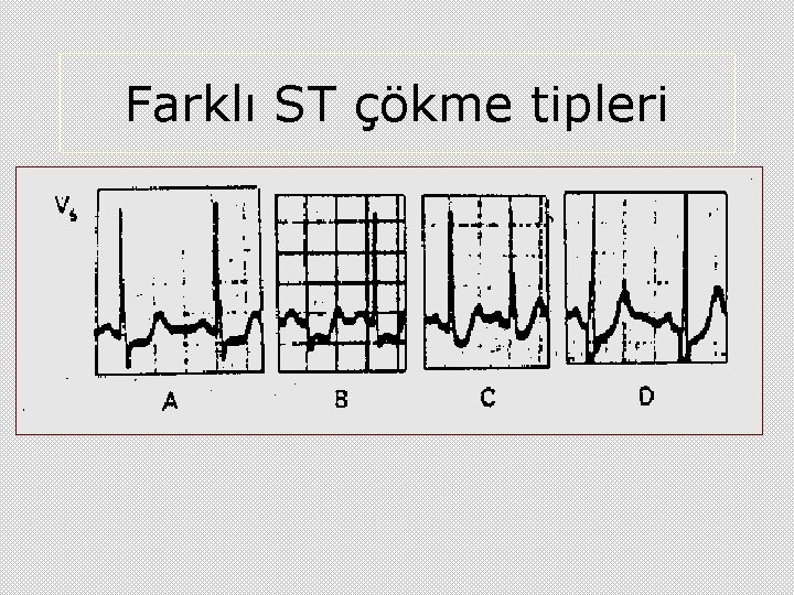 Farklı ST çökme tipleri 