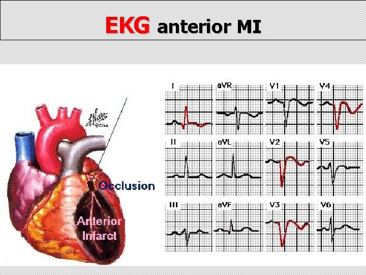 EKG anterior MI 