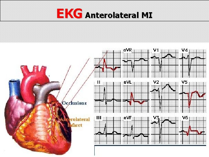 EKG Anterolateral MI 