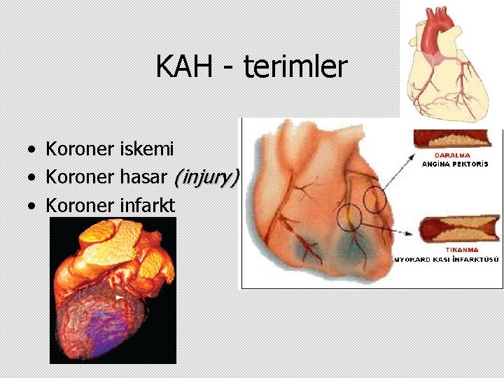 KAH - terimler • Koroner iskemi • Koroner hasar (injury) • Koroner infarkt 