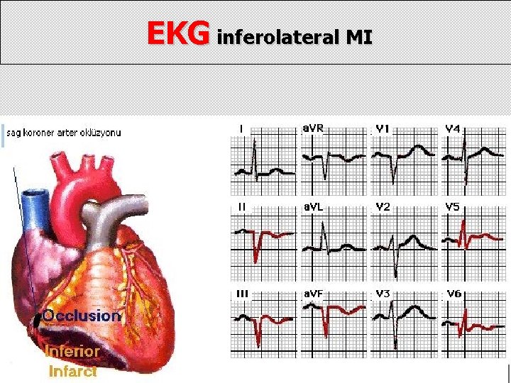 EKG inferolateral MI 