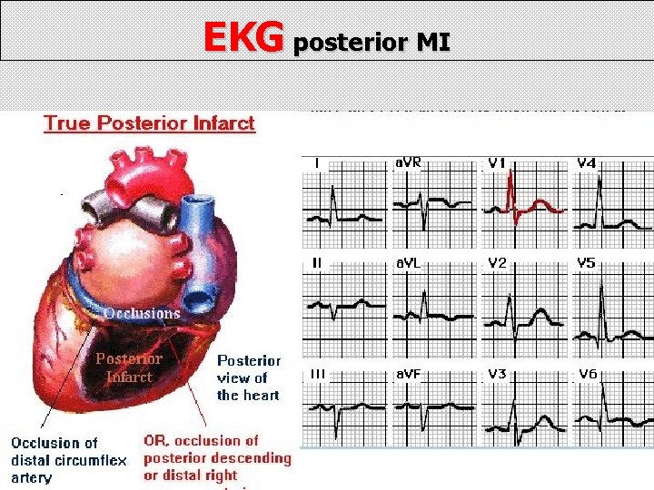 EKG posterior MI 