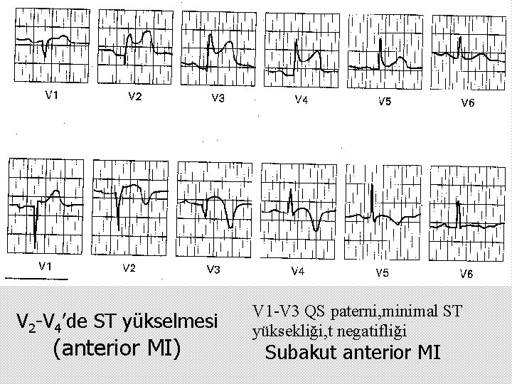 V 2 -V 4’de ST yükselmesi (anterior MI) V 1 -V 3 QS paterni,