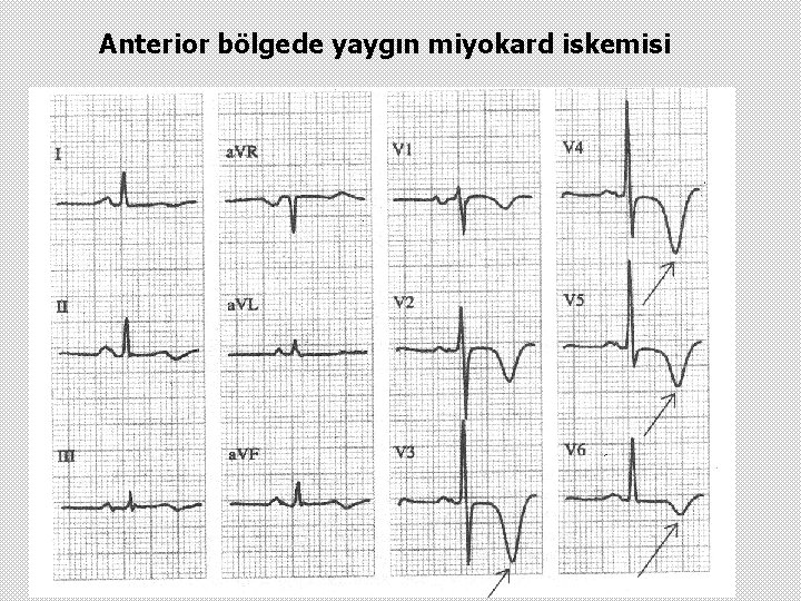 Anterior bölgede yaygın miyokard iskemisi 