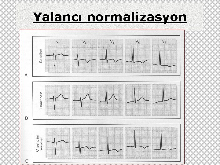 Yalancı normalizasyon 