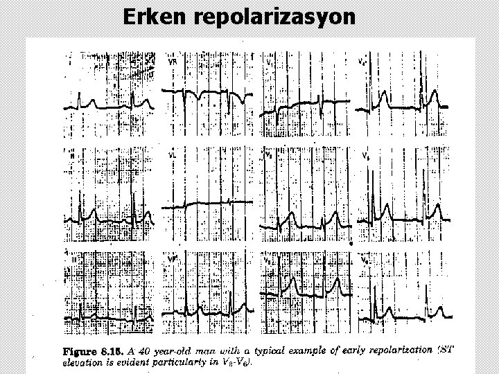 Erken repolarizasyon 