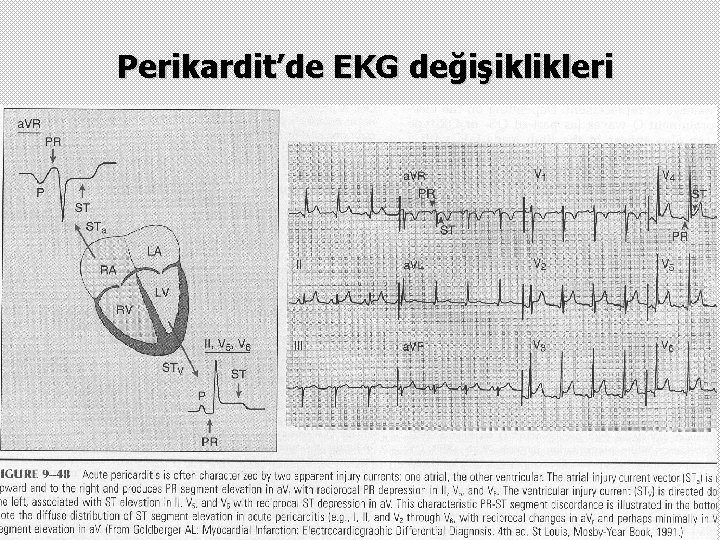 Perikardit’de EKG değişiklikleri 