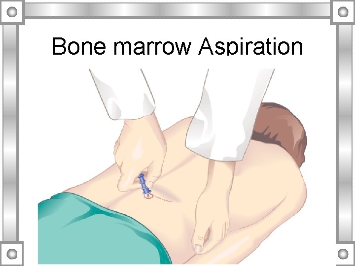 Bone marrow Aspiration 