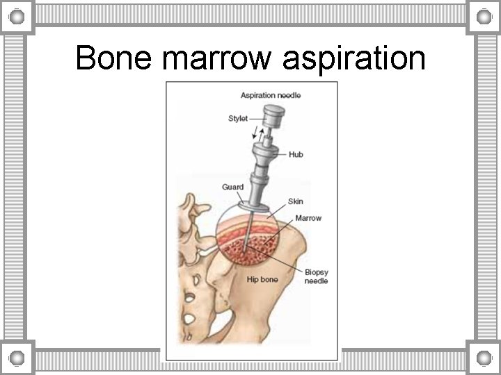 Bone marrow aspiration 