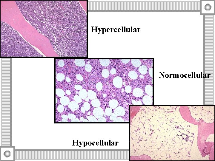 Hypercellular Normocellular Hypocellular 