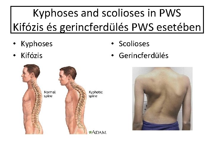 Kyphoses and scolioses in PWS Kifózis és gerincferdülés PWS esetében • Kyphoses • Kifózis