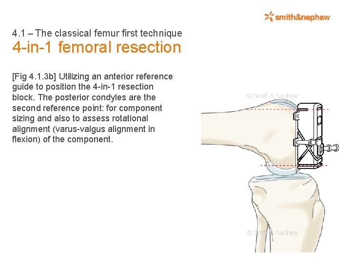 4. 1 – The classical femur first technique 4 -in-1 femoral resection [Fig 4.