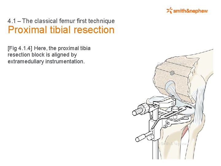 4. 1 – The classical femur first technique Proximal tibial resection [Fig 4. 1.