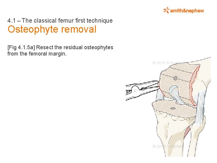 4. 1 – The classical femur first technique Osteophyte removal [Fig 4. 1. 5