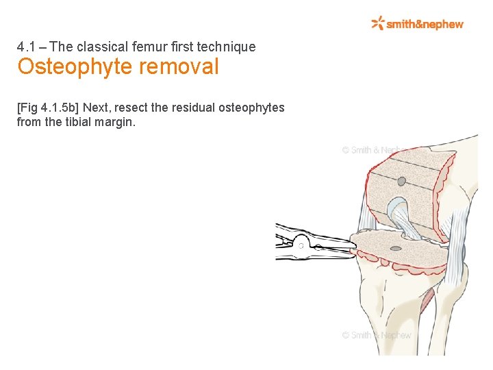 4. 1 – The classical femur first technique Osteophyte removal [Fig 4. 1. 5