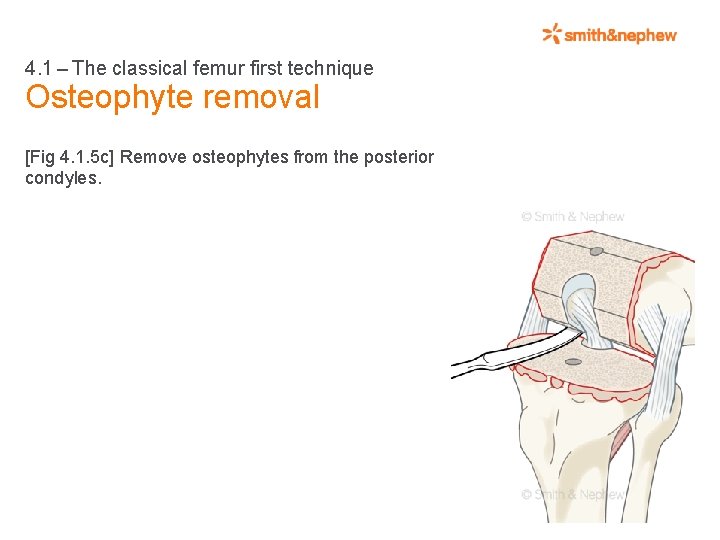 4. 1 – The classical femur first technique Osteophyte removal [Fig 4. 1. 5