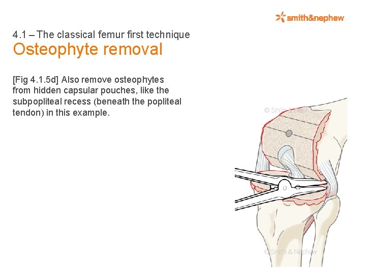 4. 1 – The classical femur first technique Osteophyte removal [Fig 4. 1. 5