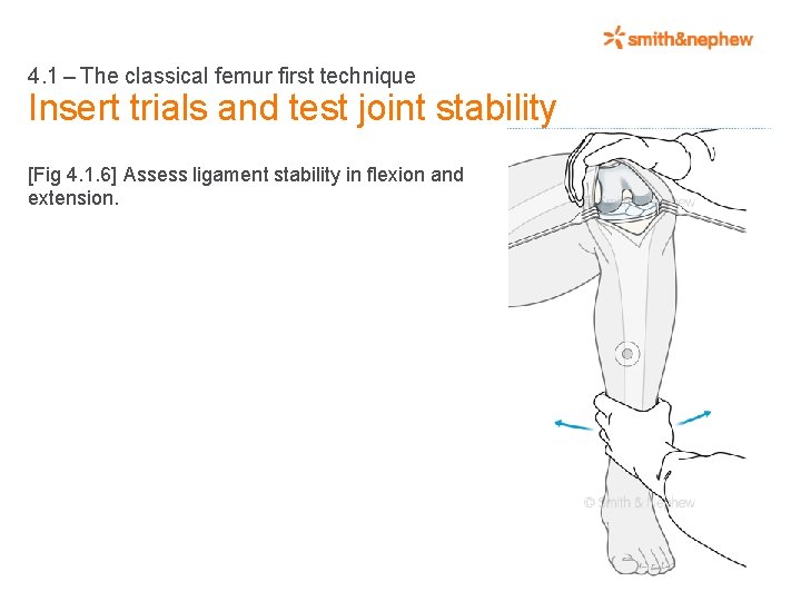 4. 1 – The classical femur first technique Insert trials and test joint stability