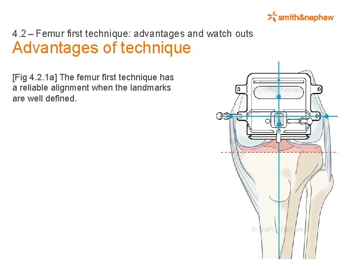 4. 2 – Femur first technique: advantages and watch outs Advantages of technique [Fig