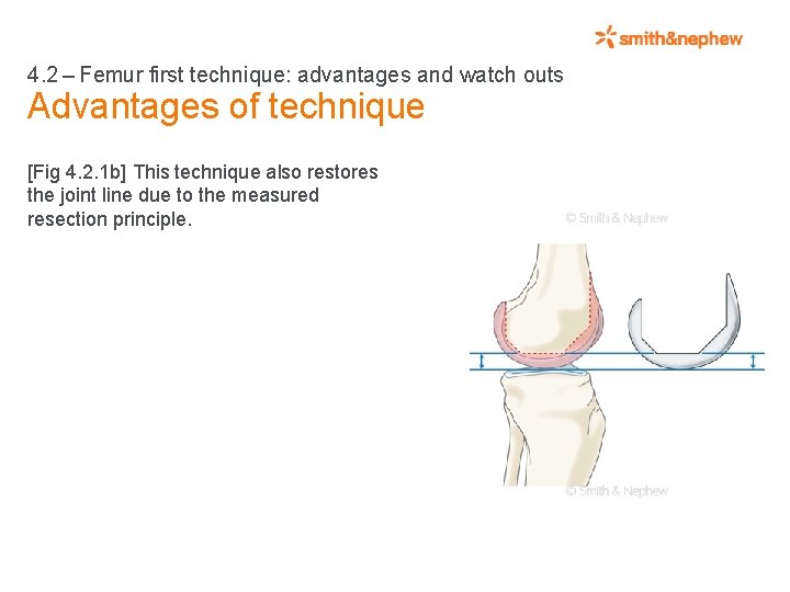 4. 2 – Femur first technique: advantages and watch outs Advantages of technique [Fig
