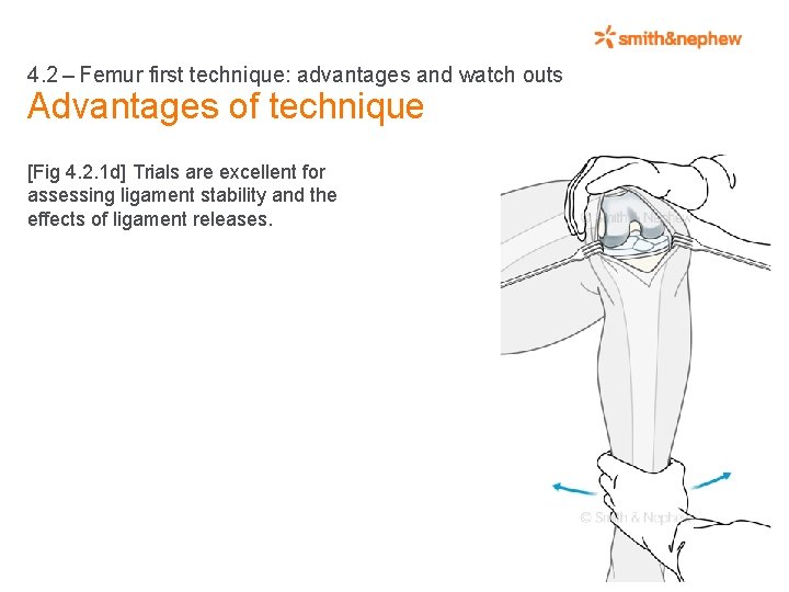 4. 2 – Femur first technique: advantages and watch outs Advantages of technique [Fig