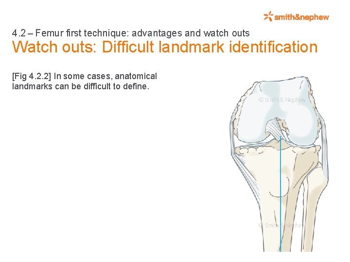 4. 2 – Femur first technique: advantages and watch outs Watch outs: Difficult landmark