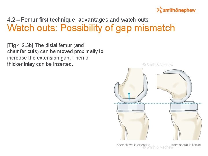 4. 2 – Femur first technique: advantages and watch outs Watch outs: Possibility of