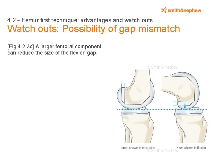 4. 2 – Femur first technique: advantages and watch outs Watch outs: Possibility of