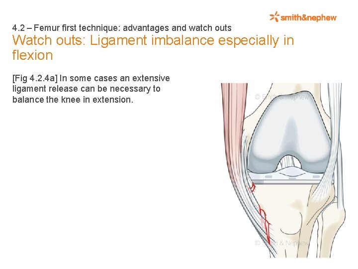 4. 2 – Femur first technique: advantages and watch outs Watch outs: Ligament imbalance