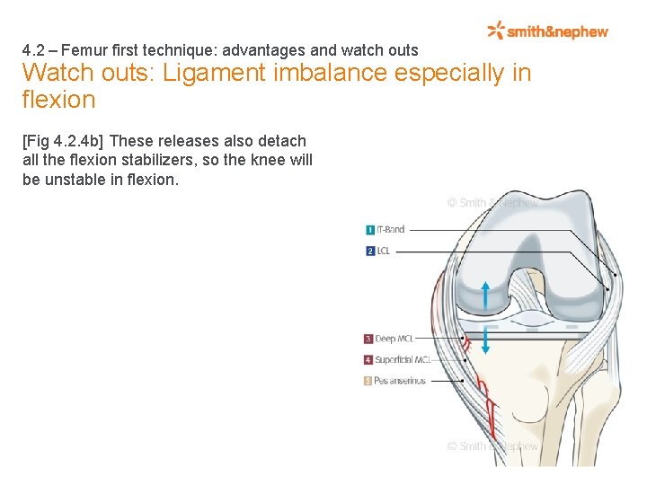 4. 2 – Femur first technique: advantages and watch outs Watch outs: Ligament imbalance