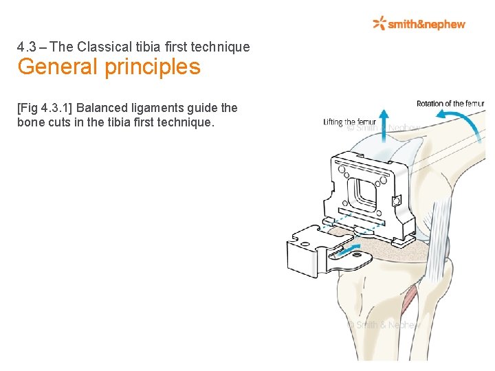 4. 3 – The Classical tibia first technique General principles [Fig 4. 3. 1]