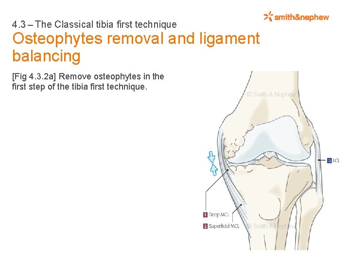 4. 3 – The Classical tibia first technique Osteophytes removal and ligament balancing [Fig