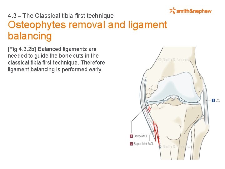 4. 3 – The Classical tibia first technique Osteophytes removal and ligament balancing [Fig