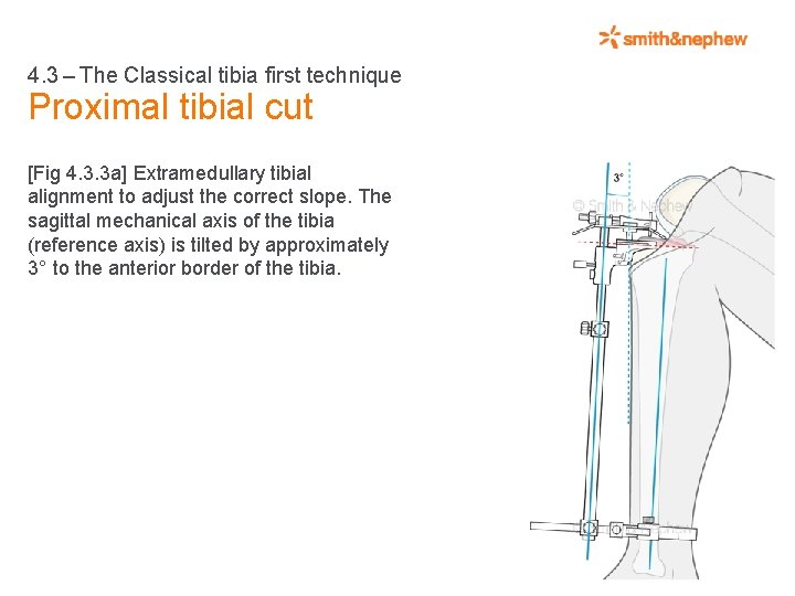 4. 3 – The Classical tibia first technique Proximal tibial cut [Fig 4. 3.