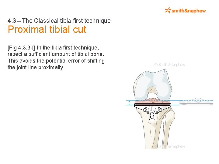 4. 3 – The Classical tibia first technique Proximal tibial cut [Fig 4. 3.