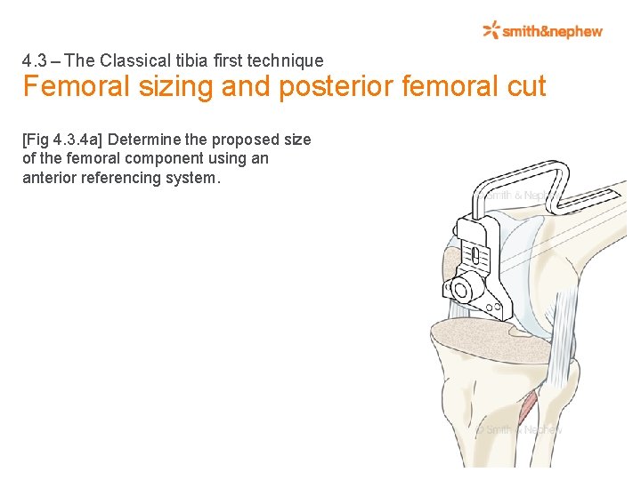 4. 3 – The Classical tibia first technique Femoral sizing and posterior femoral cut