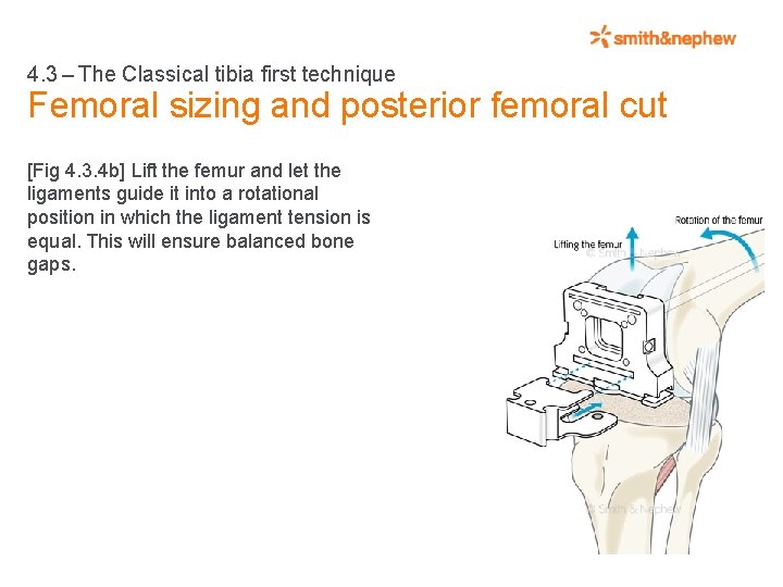 4. 3 – The Classical tibia first technique Femoral sizing and posterior femoral cut
