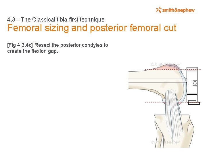 4. 3 – The Classical tibia first technique Femoral sizing and posterior femoral cut