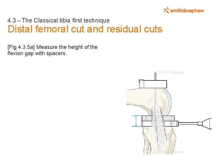 4. 3 – The Classical tibia first technique Distal femoral cut and residual cuts