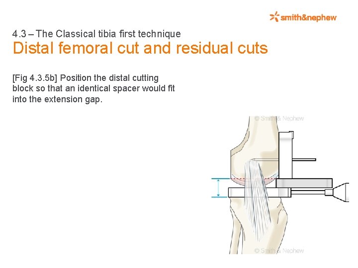 4. 3 – The Classical tibia first technique Distal femoral cut and residual cuts