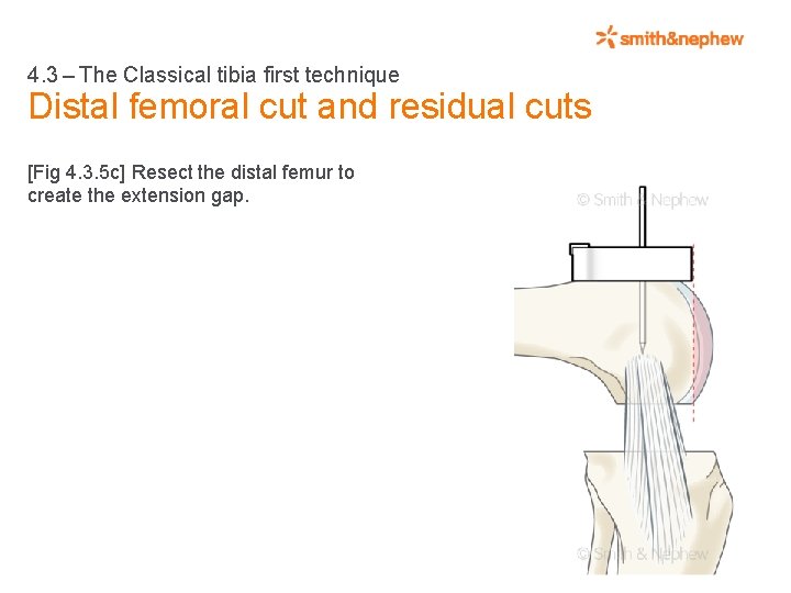 4. 3 – The Classical tibia first technique Distal femoral cut and residual cuts