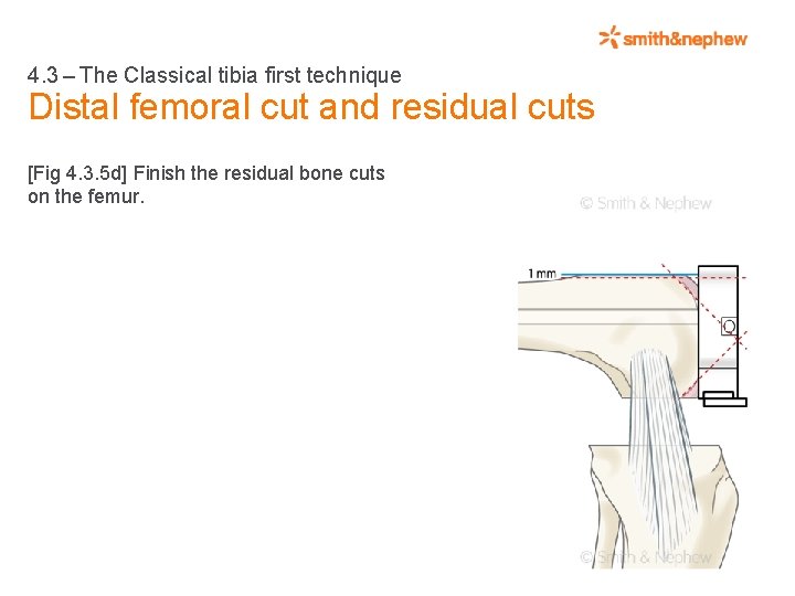 4. 3 – The Classical tibia first technique Distal femoral cut and residual cuts