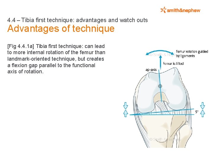 4. 4 – Tibia first technique: advantages and watch outs Advantages of technique [Fig